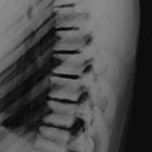 Band Appearance of Vertebral Bodies: A Case-Based Illustrative Review
