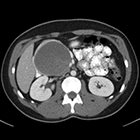 Cystic Pancreatic Mass in a Child