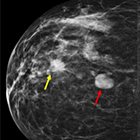 Fibroadenoma: From Imaging Evaluation to Treatment