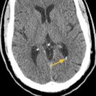 Imaging of Traumatic Intracranial Hemorrhage