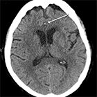 JAOCR at the Viewbox: Hyperdense Bihemispheric Anterior Cerebral Artery