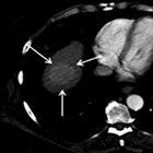 Imaging of Hepatocellular Carcinoma after Transarterial Locoregional Therapy: A Practical Review and Discussion of Treatment Res