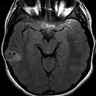 Cystic and Solid Cortically Based Mass in an Adolescent with Seizures: A Case-Based Illustrative Review