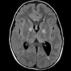 Neuroimaging Manifestations of NF1 — A Pictorial Review