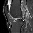 MRI of Sports-related Injuries in Adolescent Athletes