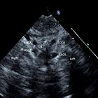 Imaging Review of Aortic Vascular Rings and Pulmonary Sling