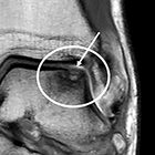 Ultrasound and MRI Evaluation of the Lateral Ankle