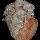 Coronary CT Angiography for Acute Chest Pain in the ER