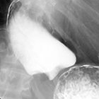 Gastroesophageal Junction Narrowing with Proximal Esophageal Dilation: A Case-Based Illustrative Review