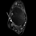 MRI of Ankle and Hindfoot Pain