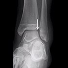 At the Viewbox: Osteochondral Defect, Unstable