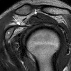 Shoulder Impingement and Associated MRI Findings