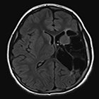 Pediatric PET/MRI: A Review