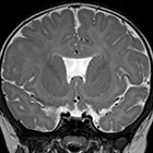 At the Viewbox: Absent septum pellucidum with ectopic posterior pituitary