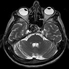 At the Viewbox: Cavernous sinus invasion with cranial nerve palsy