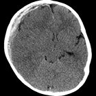 Subdural Hemorrhage in Abusive Head Trauma: Imaging Challenges and Controversies