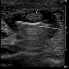Ultrasound Guided Removal of an Intratendinous Foreign Body in an Adolescent