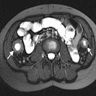 MR Enterography of Pediatric Inflammatory Bowel Disease: Review of Imaging Techniques and Findings