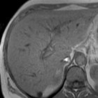 MRI of Benign Liver Lesions and Metastatic Disease Characterization with Gadoxetate Disodium