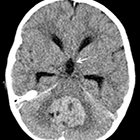 Imaging of Primary Posterior Fossa Brain Tumors in Children