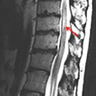 Intradural Spinal Neoplasms: A Case Based Review