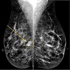 At the Viewbox: Metaplastic Breast Carcinoma