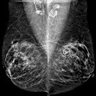 Metastatic Invasive Breast Carcinoma