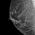 Breast Density as an Independent Risk Factor for Cancer