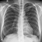 At the Viewbox: Pulmonary Lymphangioleiomyomatosis