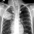 Cavitary Lung Mass in a Febrile Child