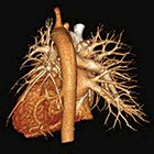 Pulmonary Vascular Anomaly