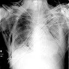Interpretive Approach and Reporting the Intensive Care Bedside Chest X-Ray 
