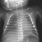 Imaging of Neonatal Lung Disease