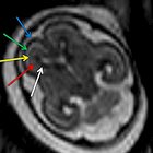 Spectrum of Fetal Brain Anomalies Depicted on Fetal MRI