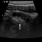 Ultrasound Evaluation for Appendicitis Focus on the Pediatric Population: A Review of the Literature