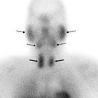 Parathyroid Adenoma Evaluation Utilizing SPECT/CT Imaging
