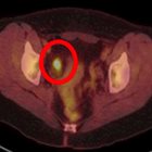 Hypermetabolic Appendiceal Activity on PET-CT