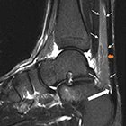 Overcoming Your Achilles Heel: A Review of Achilles Tendon Anatomy, Pathology and Associated MRI Findings